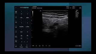 Ultrasound Guided Adductor canal block [upl. by Uyr]