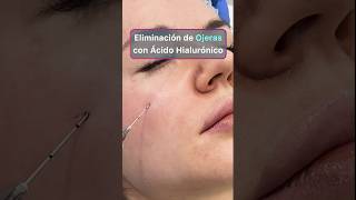 Secretos sobre eliminar ojeras con ácido hialurónico acidohialuronico ojeras [upl. by Orman323]