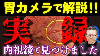 【実際の胃カメラ映像で解説‼︎】普段見られない検査の全貌！胃がんや食道がん、胃カメラ検査でこうして見つけます。 教えて久津川先生 No276 [upl. by Lah]