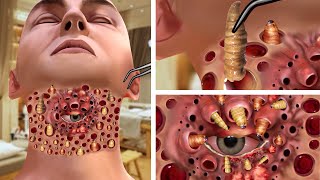 ASMR Treatment of eyes growing on neck amp Removal of large parasitic worms  Deep Cleaning Animation [upl. by Otit]