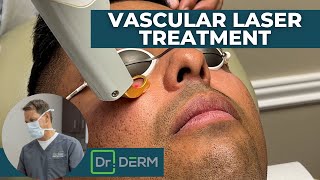 Vascular Laser Treatment for Bruise Prevention After Filler  Dr Derm [upl. by Yborian]