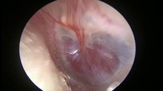 Endoscopic finding of Pulsatile glomus tympanicum [upl. by Ariel]