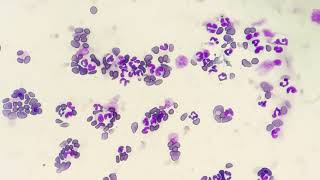 Neutrophilic Leukocytosis Blood smear examination [upl. by Noremac]