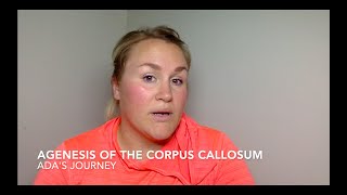 Complete Agenesis of the Corpus Callosum  More than a Diagnosis [upl. by Annatnas8]