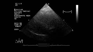 ULTRASONIDO ECOCARDIOGRAMA JUDITH BUSTAMANTE [upl. by Drolyag590]