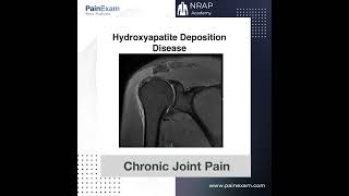 Hydroxyapatite Deposition Disease [upl. by Vine979]