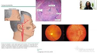 Virtual Resident Education Lecture Series Headache Medicine  American Academy of Neurology [upl. by Limak245]