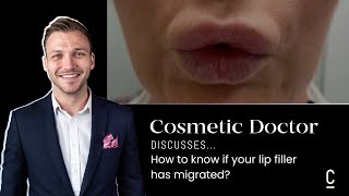 HOW TO KNOW IF YOUR LIP FILLER HAS MIGRATED [upl. by Atiras]