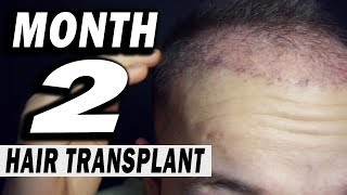 FUE Hair Transplant 2 MONTHS post op Istanbul Turkey [upl. by Haley]