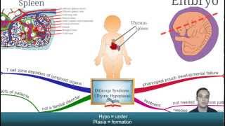 Digeorge syndrome [upl. by Stuart]