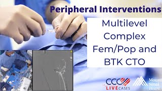 Peripheral Multilevel Complex FemPop and BTK CTO [upl. by Franek823]