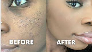 DRUGSTORE MAKEUP FOR DEEP PITTED ACNE SCARS [upl. by Ru]