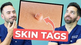 HOW TO TREAT SKIN TAGS LIKE A DERMATOLOGIST [upl. by Darooge]