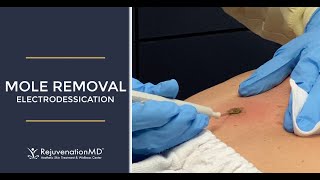 Electrodessication to Remove Seborrheic Keratosis [upl. by Ranie]