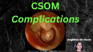 037 Complications of Suppurative Otitis Media csom [upl. by Anesusa790]