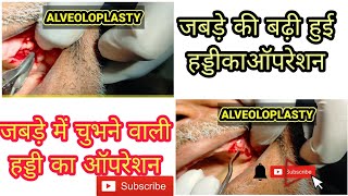 Alveoloplasty  bone removal surgerybony spicule removal in old patient draquil5454 [upl. by Buyse849]