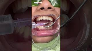 Root Canal Treatment in Kolkata  RCT Procedure Step by Step rootcanaltreatment dental dentistry [upl. by Ammeg]