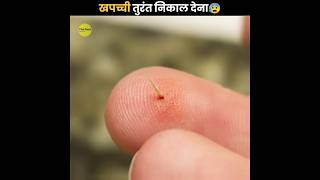 Splinter को तुरंत निकाल देना 😰  Remove Splinter Immediately  The Fact  shorts ytshorts [upl. by Leahcimauhsoj736]