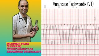 VENTRICULAR TACHYCARDIA BY DRSUMIT TYAGISUMITMEDICALDISPENSARY1 [upl. by Sucramel]