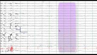 EEG Reading Rounds EEG in Frontal Lobe Epilepsy [upl. by Mick]