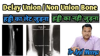 Delayed Union  Non Union  Delayed union or non union treatment  causes of non union  in Hindi [upl. by Nedearb978]