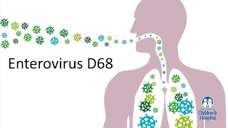 Enterovirus D68  Pediatric Expert Tips [upl. by Conan]