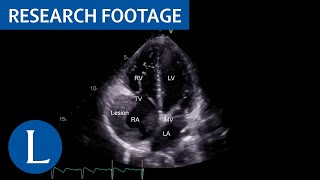 Severe disseminated tuberculosis in HIVnegative refugees video 1 of 2 [upl. by Hawkie610]