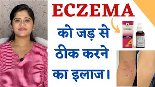 Eczema Treatment ॥ Skin Allergy और Eczema को जड़ से ठीक करने का इलाज ॥ [upl. by Atalee32]