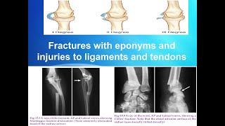 Fractures with eponyms and ligament injury [upl. by Uyekawa296]