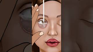 asmr Eye Stone Removal amp Eyelid Sebum Extrusion Meibomian Gland Cleaning animation beauty [upl. by Dunson]