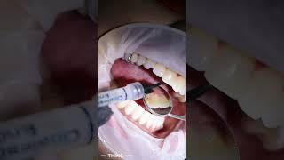 Internal Bleaching treatment on root canal treated tooth by Dr Terence Moodley dentist  dentistry [upl. by Munshi885]