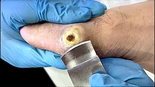 Foot warts treatmentampExcision of lateral verruca of thumb【asmr】 [upl. by Leirbaj]