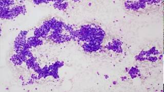 Acinic cell carcinoma FNA Cytology [upl. by Nilecoj]