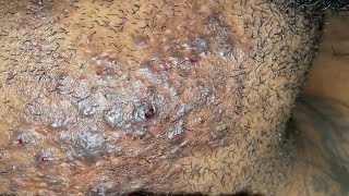 Super Satisfying Ingrown Hair Removal 4 [upl. by Adnawal]