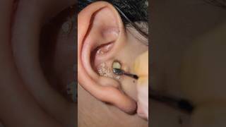 The best method for ear wax removal [upl. by Arehahs]