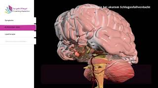 Lysetherapie bei akutem Schlaganfallverdacht [upl. by Anairotciv]
