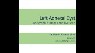 Sonographic view of Adnexal Cyst II Images amp live scan II Dr Nasrin Fatema [upl. by Sakmar]