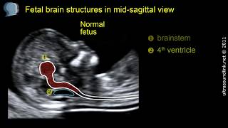 Open spina bifida at 1113 weeks gestation brainstem [upl. by Anaihsat860]