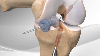 Rupture du ligament croisé antérieur  Chirurgie reconstruction LCA ligamentoplastie  Dr Tournemine [upl. by Meekar]