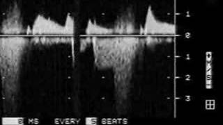 Diastolic Mitral Regurgitation [upl. by Keelby]