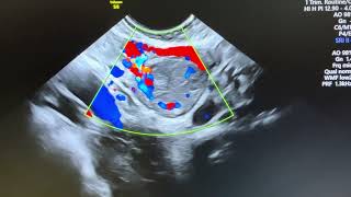 7mm wall thickness of corpus luteum in 5 weeks pregnancy Wall is homogenously smooth [upl. by Leonora]