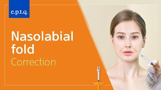 Nasolabial fold correction [upl. by Appleton]