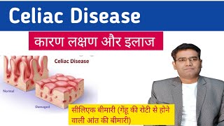 Celiac disease Cause Symptoms Tests and Treatment explained in Hindi  Gluten Enteropathy [upl. by Cleopatre274]