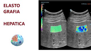 Elastografía Hepática por Ecografía [upl. by Gerdi]