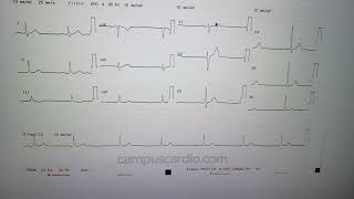 Electrocardiograma parte 11 medicina [upl. by Murdock]