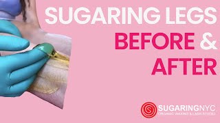 Sugaring Legs Before amp After Results from Sugaring NYC [upl. by Sprung]