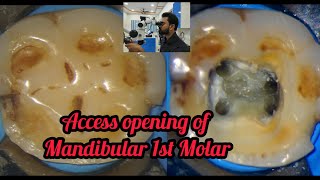 Access opening of Mandibular1st Molar step by step demonstration Rct for beginners dentallectures [upl. by Nunci668]