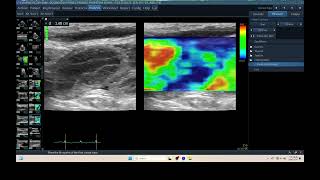 IQ 315 PYOMETRA ULTRASOUND ECHOPAC ANALYSIS UTERUS ELASTOGRAPHY [upl. by Ennayar]