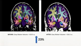 Dementogens Exposome and Alzheimers The Hidden Epidemic [upl. by Selrahcnhoj955]