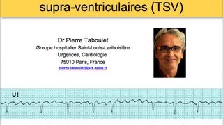 6a Classification des tachycardies supraventriculaires ECG Dr Taboulet [upl. by Llertnauq482]